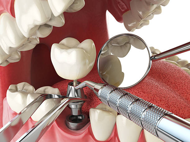 Best Emergency Dental Care for Broken or Chipped Teeth in Labelle, FL
